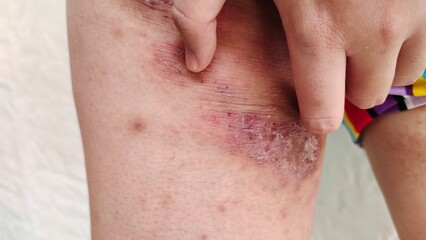 Fototapeta premium close up of a teenage patient, rash and hives, inflammation and allergic, reaction and scratch, symptom and allergy on the body, health care and medical concept.