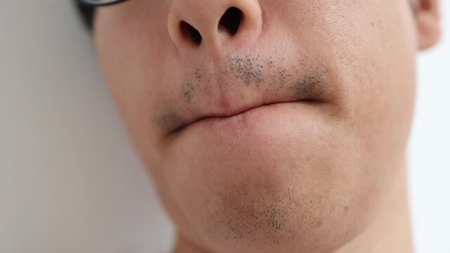 髭脱毛5回後の男性。口周りと顎のまだらに残った髭の状態。