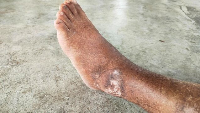 The effects of scabs on calves and feet due to diabetes. Chronic Venous Insufficiency with reticularitis and hyperpigmentation. 