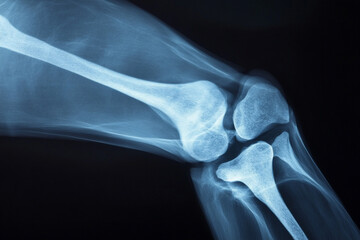 膝関節のレントゲン写真