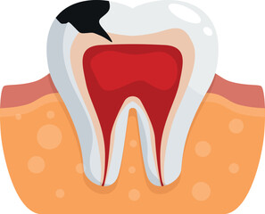 Cross section of molar showing pulpitis inside gums with black decay on surface, emphasizing dental health and care