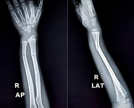 Pediatric right distal radius fracture with associated ulnar greenstick fracture &mdash; AP & lateral radiographs