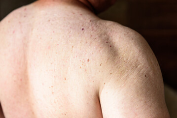 Naklejka premium Red pimples on a man's back. Skin irritation and allergy concept. Diseases of the gastrointestinal tract.