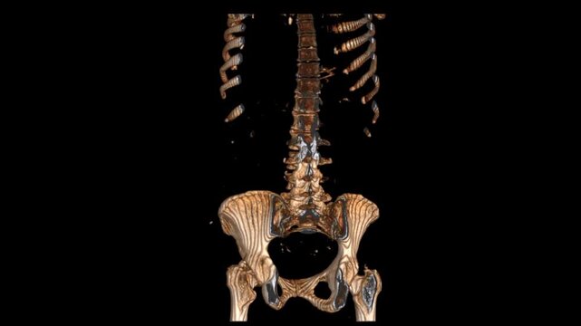 KUB coronal VR scan showcasing detailed kidney, ureter, and bladder anatomy. Ideal for abdominal imaging, urological assessment, and medical diagnostic research.