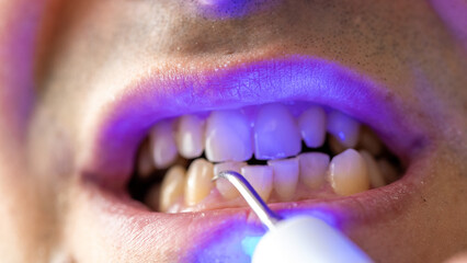 Naklejka premium Close-Up of a Dental Hygienist Cleaning Teeth with a Mini Tartar Removal Device 