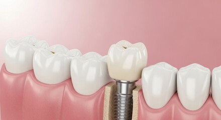 A dental implant with a crown and bridge in place.
