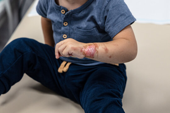 Poparzona ręka u dziecka