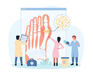 Diagnosis of gout vector illustration. Cartoon tiny people study infographic foot medical diagram, doctors diagnose arthritis inflammation and pain in joint articulation due to uric acid crystals