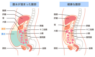 腹水が溜まった腹部と、健康な腹部