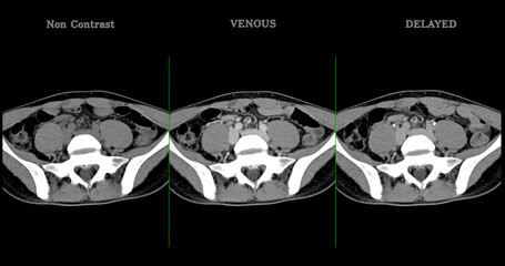  High-resolution CT scan Lower abdomen showing a normal lower abdomen for diagnostic reference,and healthcare presentations.Clear anatomical highlight healthy abdominal structure.