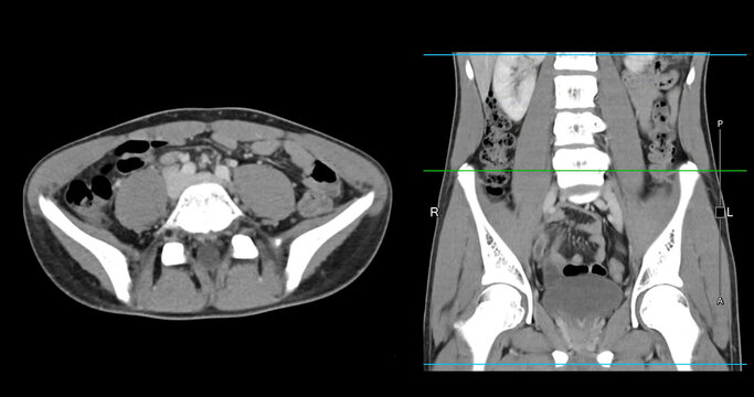  High-resolution CT scan Lower abdomen showing a normal lower abdomen for diagnostic reference,and healthcare presentations.Clear anatomical highlight healthy abdominal structure.