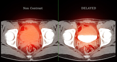  High-resolution CT scan Lower abdomen showing a normal lower abdomen for diagnostic reference,and healthcare presentations.Clear anatomical highlight healthy abdominal structure.