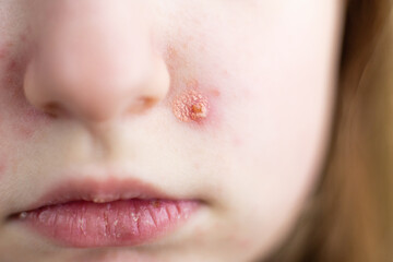 Child having impetigo skin infection chicken pox on face
