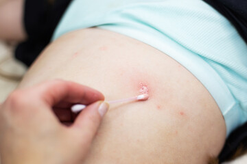 Parent applying cream to child's chickenpox rash