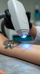 Laser tattoo removal. Woman getting old tattoo removed from arm. Cosmetic procedure in clinic for skin rejuvenation.