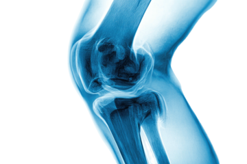 Medical X-ray illustration of a human knee joint, showing bones and cartilage in a blue hue