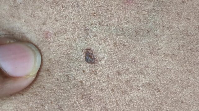 Closeup of finger touch and check small dark color mole or skin tag growth hang on body. Dermatology, skincare, melanoma, tumor or lesion concept.