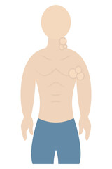 Fototapeta premium Enlarged lymph nodes. Color vector illustration. The patient has swollen lymph nodes in the neck and armpits. A symptom of problems in the body. Isolated background. Flat style. Medical theme.