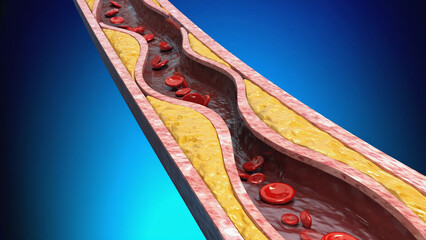 Atherosclerosis with cholesterol blood or plaque in vessel cause of coronary artery disease