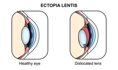 Ectopia lentis illustration, torn zonular fibers. Healthy eyes and vision disorders, genetic diseases. Ophthalmology appointment. Vector illustration of eye health, poster for medical and education