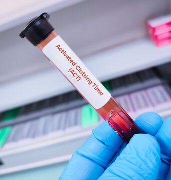 Blood sample for Activated Clotting Time (ACT) test to measures how long it takes for blood to clot and is crucial for monitoring anticoagulation therapy, especially during surgical procedures.