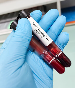 Blood sample for Activated Clotting Time (ACT) test to measures how long it takes for blood to clot and is crucial for monitoring anticoagulation therapy, especially during surgical procedures.