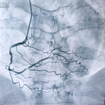 Coronary angiogram of right coronary artery during cardiac catheterization with contrast dye. Abnormal findings. Colour adjust.