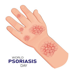 World Psoriasis Day (October 29) concept with human hand infected