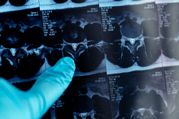 Mri scan of human spine showing disc protrusion with doctor's gloved finger pointing