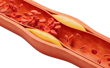Blood vessel with blood fat in it, 3d rendering.
