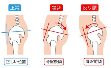 正しい姿勢と猫背と反り腰　背骨と骨盤
