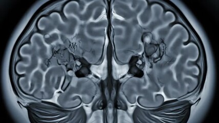 Dynamic brain scan reveals intricate neural pathways for medical research and educational resources about neurology and brain health