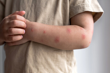 Close up of child s arm with multiple red bite marks and scratches, symbolizing insect bites, skin irritation, allergy, or mosquito bites in summer