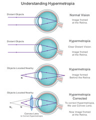 Illustration showing Hypermetropia or farsightedness where distant objects appear clear but nearby objects are blurred, explained with human eye structure and lens diagram.