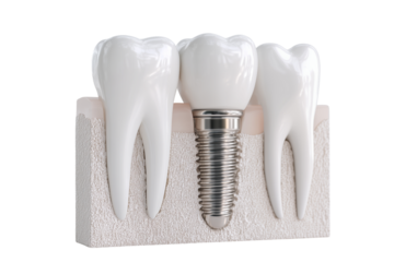Dental implant model showcasing realistic teeth and titanium fixture for educational purposes in a dental clinic setting Generative AI