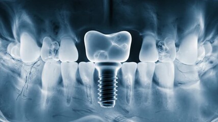 Dental Implant X Ray Showing Artificial Tooth Replacement Procedure.