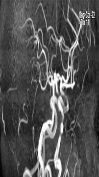 MRA Scan of Cerebral Arteries &ndash; Magnetic Resonance Angiography Blood Vessel Imaging