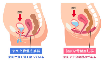 衰えた骨盤底筋群と健康な骨盤底筋群