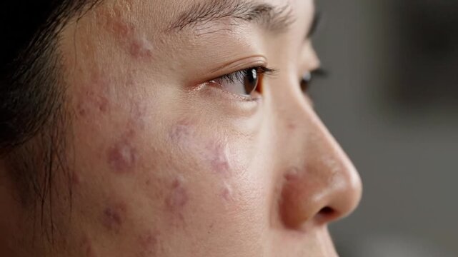 Close Up of Asian Woman's Face Revealing Scarring and Inflammation from Acne Condition Showing the Reality of Skin Imperfections and Treatments in a Studio with Natural Lighting
