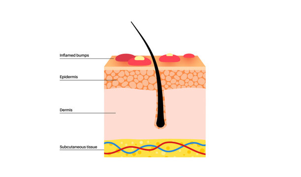 Dermatitis skin disease