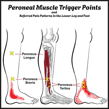 Peroneal Muscle Trigger Points and Referred Pain Patterns in the Lower Leg and Foot