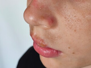 Fototapeta premium Close-up view of a child skin with blemishes on the face