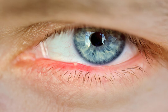 Lower eyelid showing painful red bump caused by stye bacterial infection or demodex mite inflammation resulting in swollen skin and irritation near the eyelashes. Eyelid stye closeup. Selective focus
