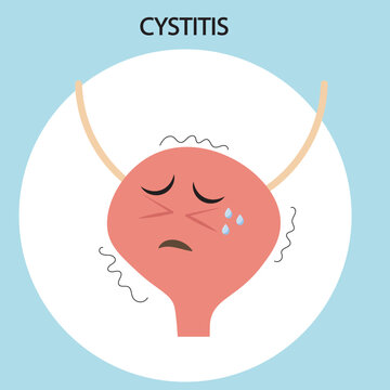 Medical vector illustration of cystitis showing bladder pain, burning urination, urgency, and discomfort. Includes comparisons with urethritis and kidney infection symptoms. crying