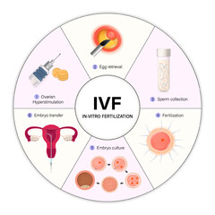 In-Vitro Fertilization. IVF Process Step-by-Step. Fertility treatment. Assisted reproductive technology.