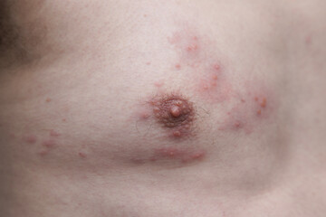 Fototapeta premium Close-up image showing the skin rash and blisters typical of Shingles Herpes Zoster. Used for medical education, dermatology reference, and awareness of viral skin infections.