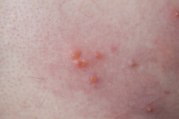 Fototapeta premium Close-up image showing the skin rash and blisters typical of Shingles Herpes Zoster. Used for medical education, dermatology reference, and awareness of viral skin infections.