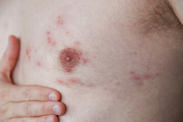 Fototapeta premium Close-up image showing the skin rash and blisters typical of Shingles Herpes Zoster. Used for medical education, dermatology reference, and awareness of viral skin infections.