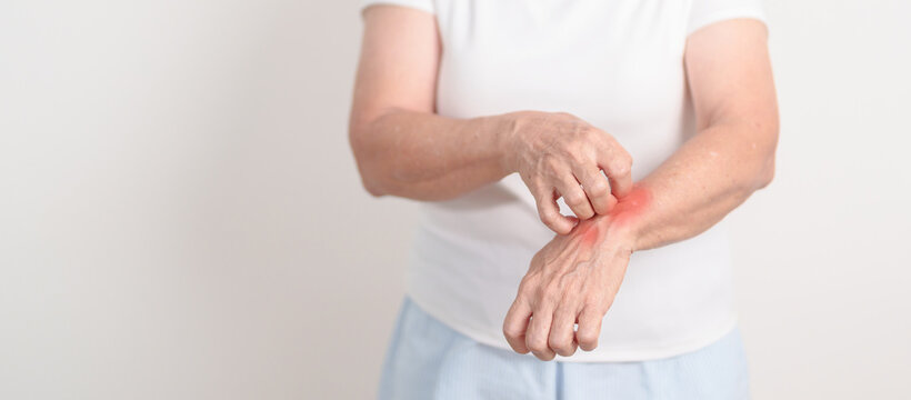 Elderly woman itching arm and body scratching for Skin Allergy from insect bite and food dermatitis. Dermatology, Leprosy day, Systemic lupus erythematosus, Psoriasis, Urticaria and rash Eczema