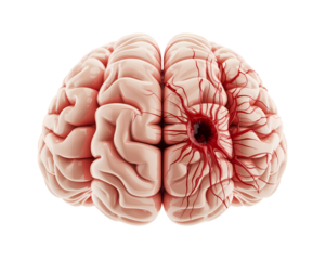 3d rendered illustration of human damage brain on transparent background.